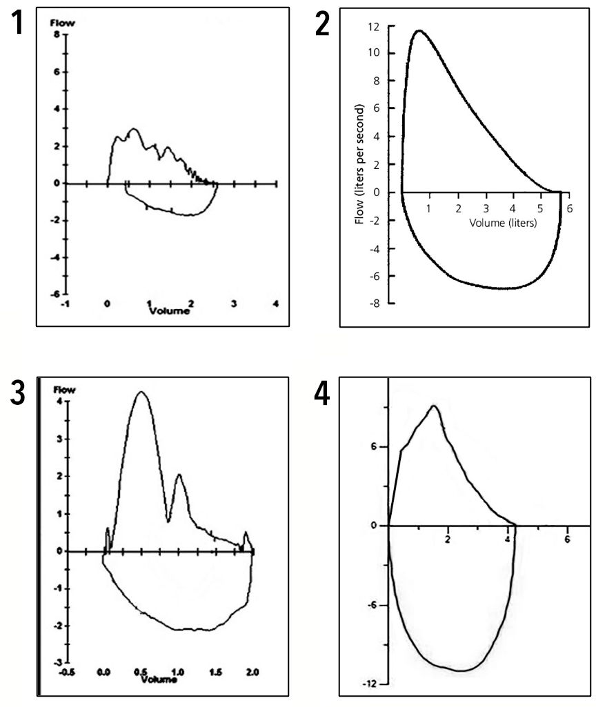 Flow Volume Loop Charts
